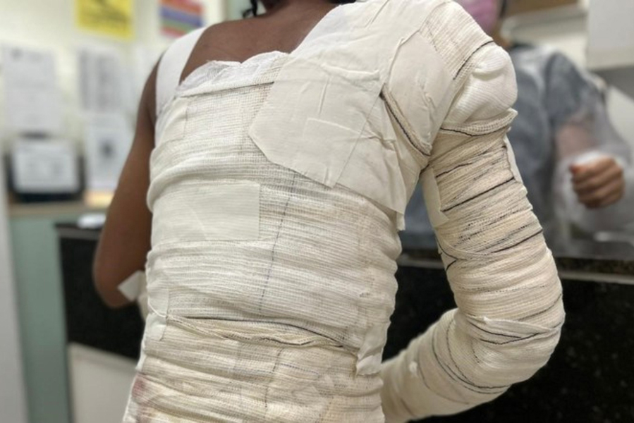 Proposta quer assegurar assistência integral e cirurgias reparadoras para vítimas de queimaduras