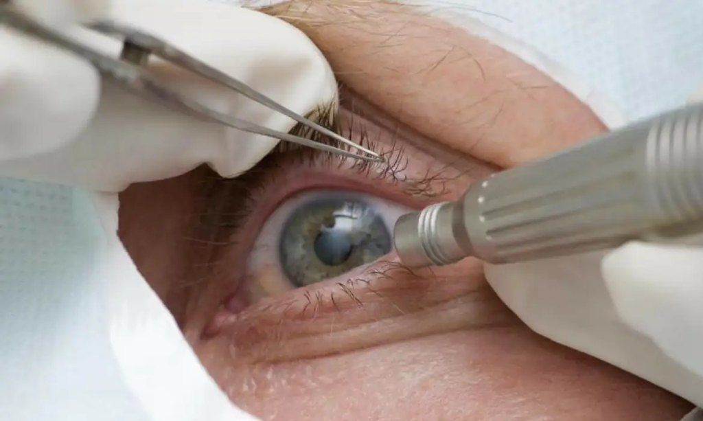 SUS vai incorporar cirurgia para tratar catarata e glaucoma simultaneamente